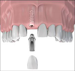 Quy trình điều trị implant cho răng cửa