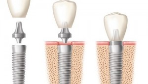 Quy trình điều trị implant cho răng cửa