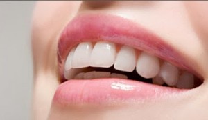 Lựa chọn niềng răng thẩm mỹ khi hô hàm dưới