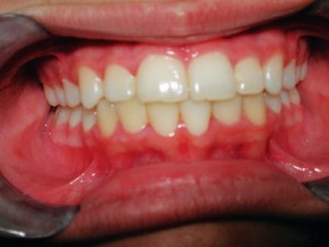 Niềng răng hô có lợi ích gì ?