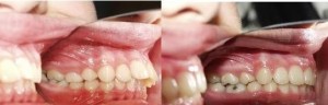 Niềng răng hô có lợi ích gì ?