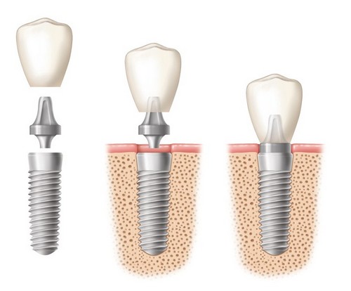 Địa chỉ trồng răng implant uy tín