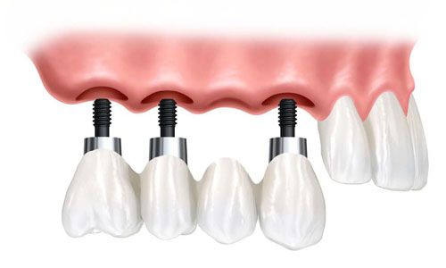 Những tác hại nếu bạn không trồng răng implant