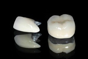 Những ưu điểm và hạn chế của răng sứ titan