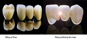 Những ưu điểm và hạn chế của răng sứ titan