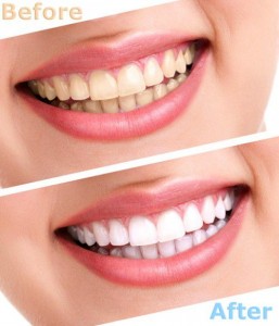 Phương pháp tẩy trắng răng giúp bạn tự tin hơn