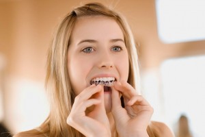 Niềng răng có cần nhổ răng