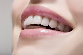 Niềng răng khấp khểnh mất thời gian bao lâu ?