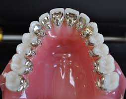 Niềng răng khấp khểnh mất thời gian bao lâu ?