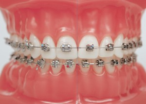 Quy trình niềng răng bằng mắc cài kim loại