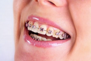 Quy trình niềng răng bằng mắc cài kim loại