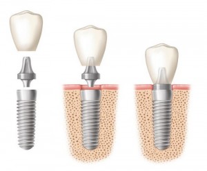 Trồng răng implant bị đau có lâu không?