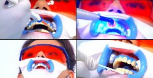 Trước khi tẩy trắng răng cần vệ sinh răng miệng 
