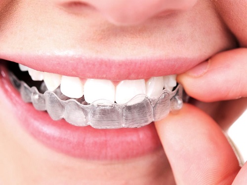 Những đặc điểm về niềng răng bằng nhựa-1