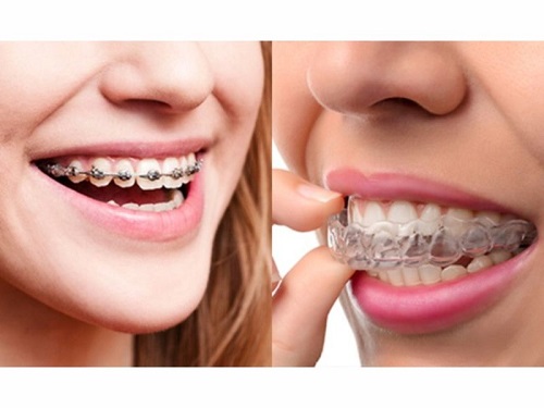 Những đặc điểm về niềng răng bằng nhựa-2