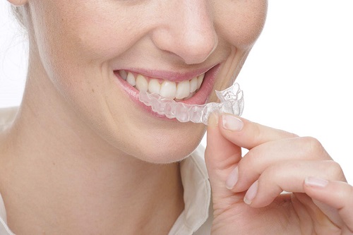 Những đặc điểm về niềng răng bằng nhựa-3