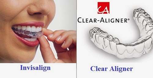 Những đặc điểm về niềng răng bằng nhựa-4