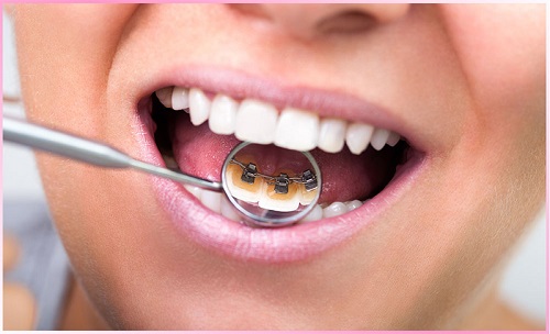 Niềng răng mắc cài mặt lưỡi-2 Niềng răng mắc cài mặt lưỡi-2