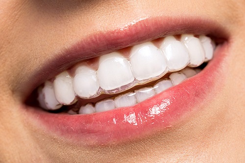 Niềng răng trong suốt có tốt không?-4 Niềng răng trong suốt có tốt không?-4
