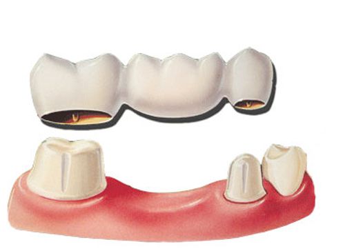 Nên cấy ghép Implant hay hàm giả cầu răng ?