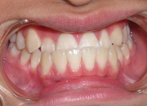 Răng bị móm có bọc răng sứ được không?