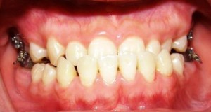 Răng bị móm có bọc răng sứ được không?