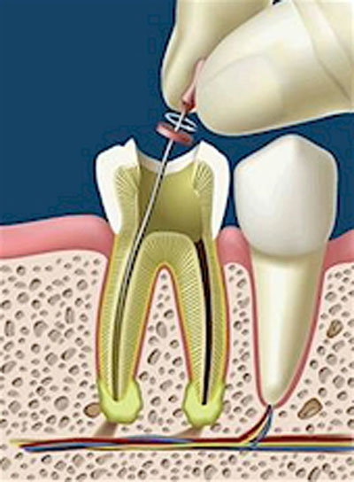 Trường hợp bọc răng sứ cần lấy tủy răng
