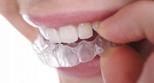 Không mắc cài khi niềng răng có hiệu quả không ?