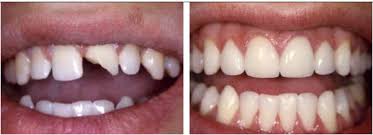 Những phương pháp điều trị cho răng cửa