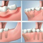 Phục hình răng giả cho răng hàm