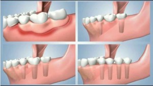 Phục hình răng giả cho răng hàm
