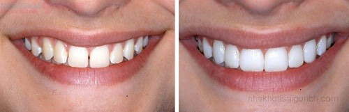 Phục hình thẩm mỹ cho hàm răng