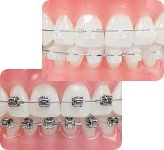 Phương pháp chỉnh nha niềng răng cho trường hợp hô