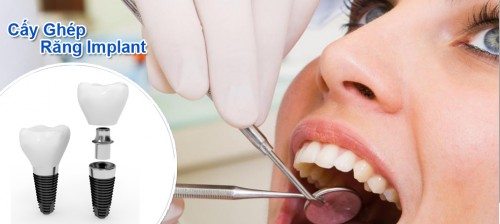 Phương pháp nào giúp phục hình răng giả vĩnh viễn