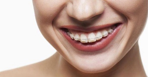 Phương pháp chỉnh nha niềng răng cho trường hợp hô 3 Phương pháp chỉnh nha niềng răng cho trường hợp hô 3