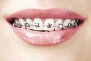 Quy trình niềng răng bằng mắc cài kim loại