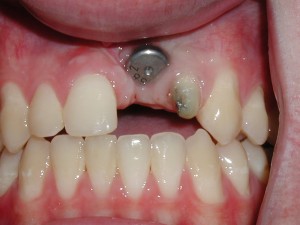 Trồng răng cửa vĩnh viễn giá bao nhiêu? 2