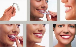 Niềng răng nhựa phù hợp cho những người bận rộn 