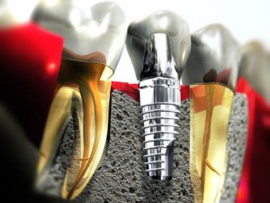 Trồng răng implant có nguy hiểm hay không? 
