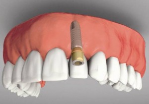 Trồng răng implant có nguy hiểm hay không? 