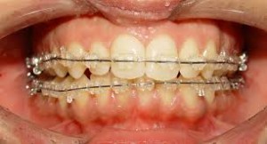 Chi phí niềng răng mọc lệch