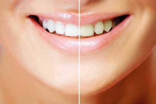 Giúp răng của bạn được trắng sáng hơn