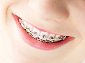 Những phương pháp niềng răng hiện nay