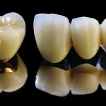 So sánh răng sứ titan với sứ Emax