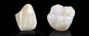 So sánh răng sứ titan với sứ Emax
