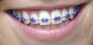 Phải làm gì khi niềng răng ?