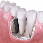 Trồng răng bị mất với trụ implant
