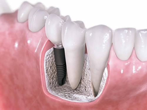 Trồng răng bị mất với trụ implant
