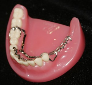 Ưu và nhược điểm của hàm răng giả tháo lắp