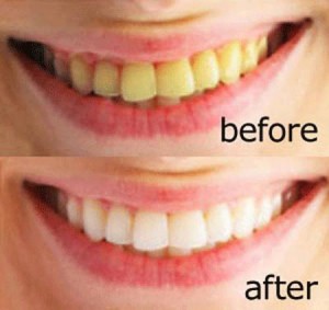Có bao nhiêu cách khắc phục men răng bị vàng
